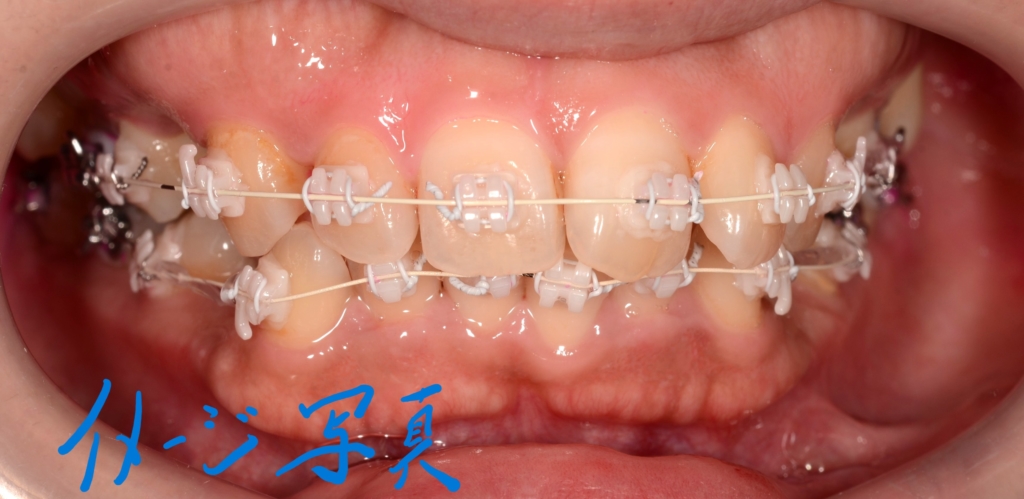 フルホワイトタイプ( 上下とも白いブラケット＆白いワイヤー）のマルチブラケットシステムにて矯正治療を開始