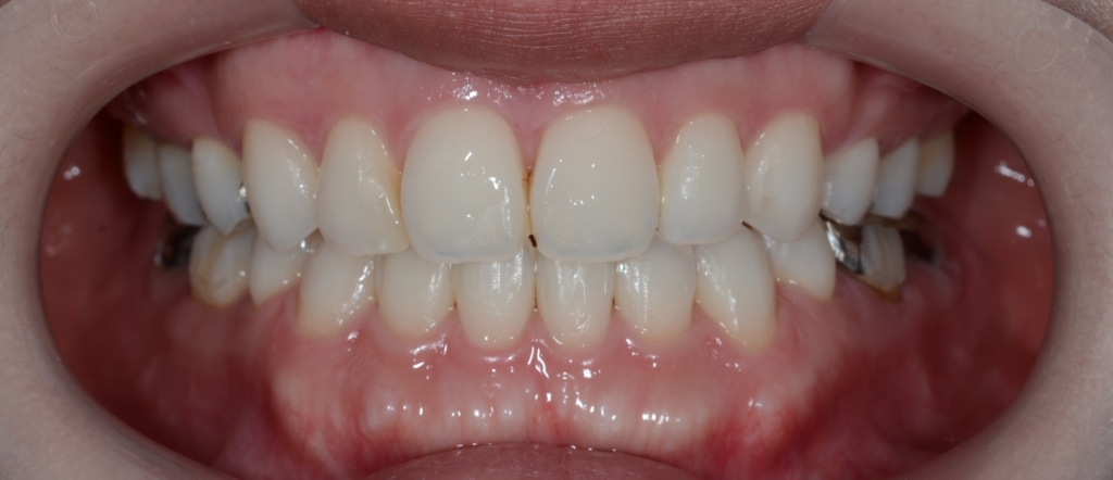 口ゴボを矯正した後の歯並び