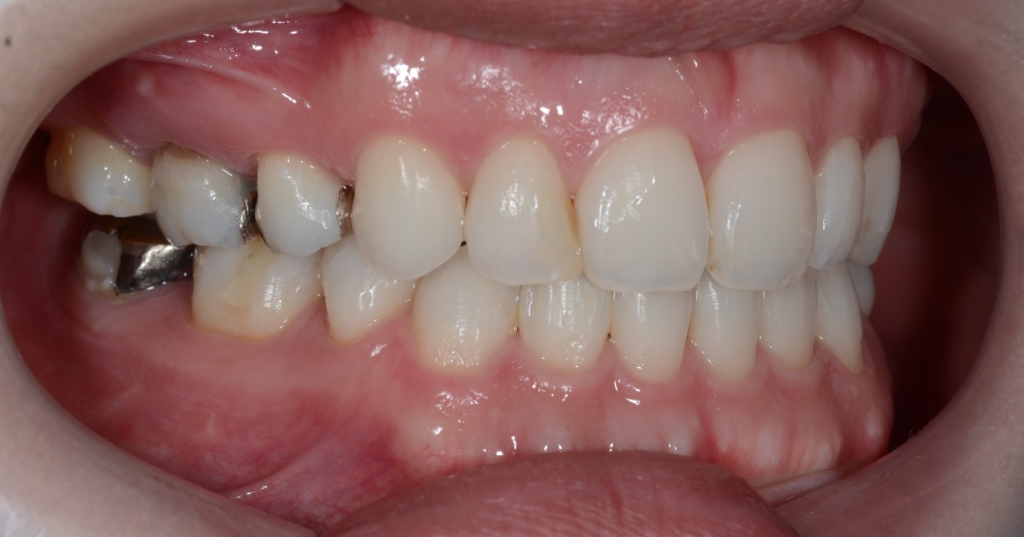 口ゴボを矯正した後の歯並び