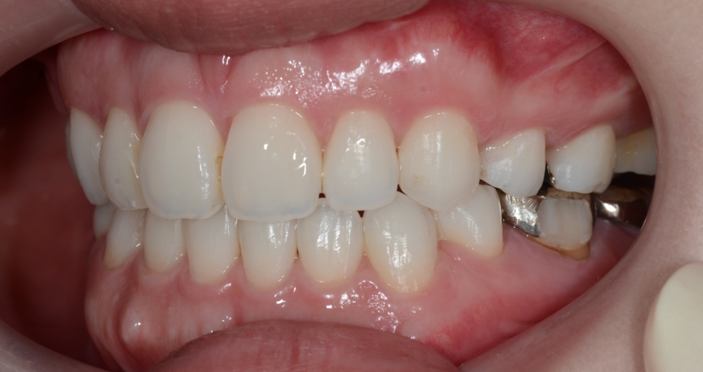 口ゴボを矯正した後の歯並び