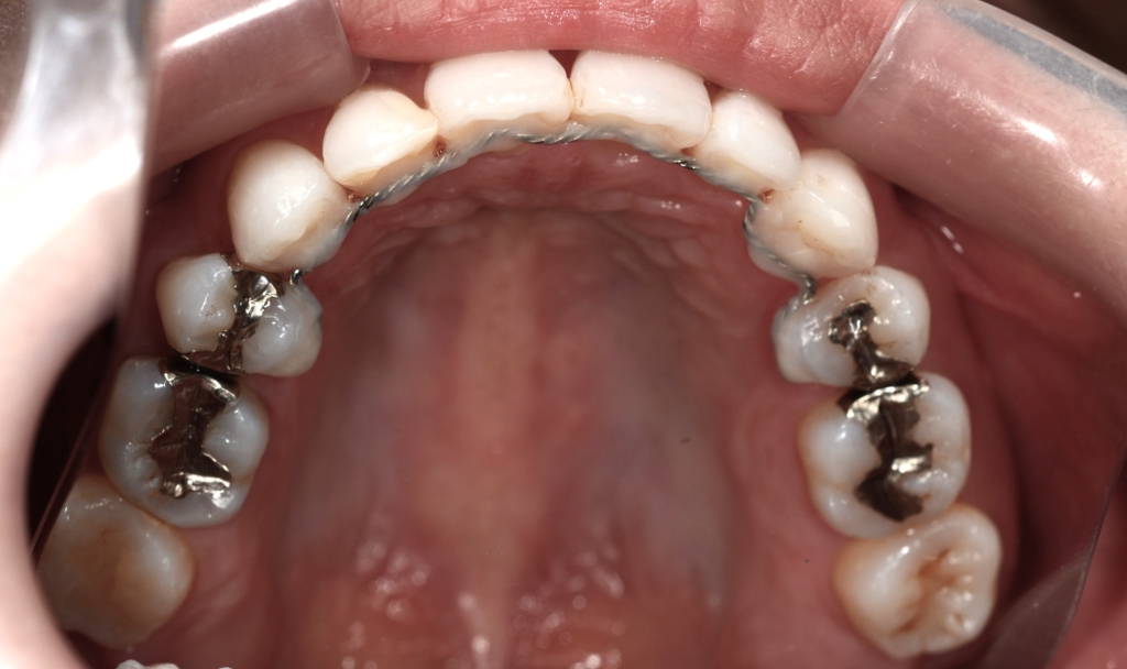 口ゴボを矯正した後の歯並び