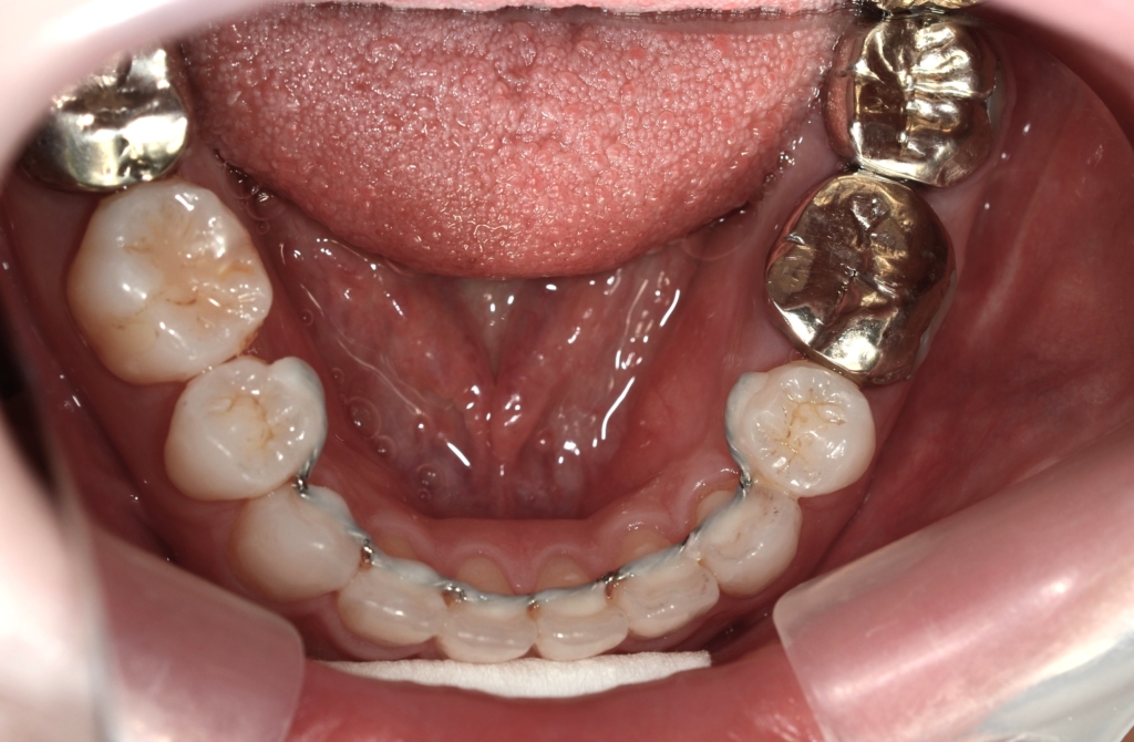口ゴボを矯正した後の歯並び