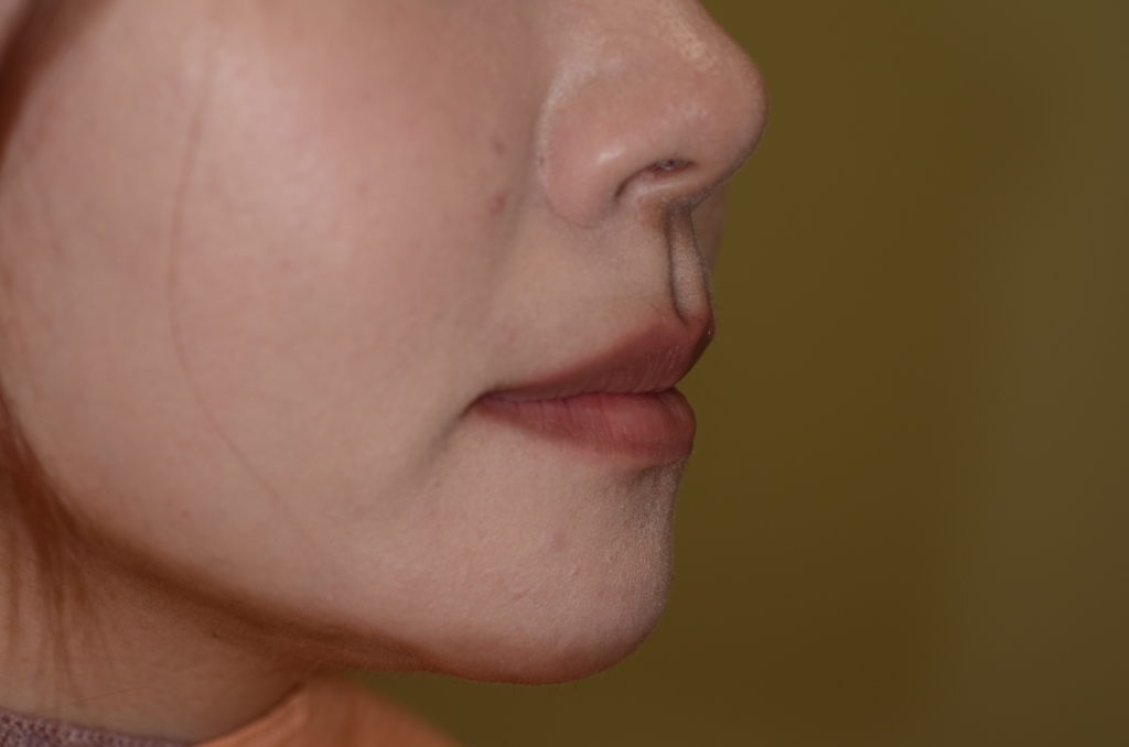 口ゴボを矯正した後の横顔と口元