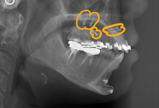 アンカースクリューの植立(上顎の口蓋正中部、上顎の臼歯部頬側と前歯部頬側)