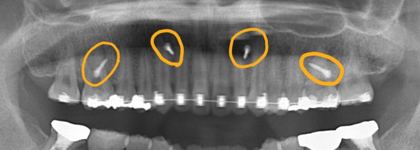 アンカースクリューの植立(上顎の口蓋正中部、上顎の臼歯部頬側と前歯部頬側)