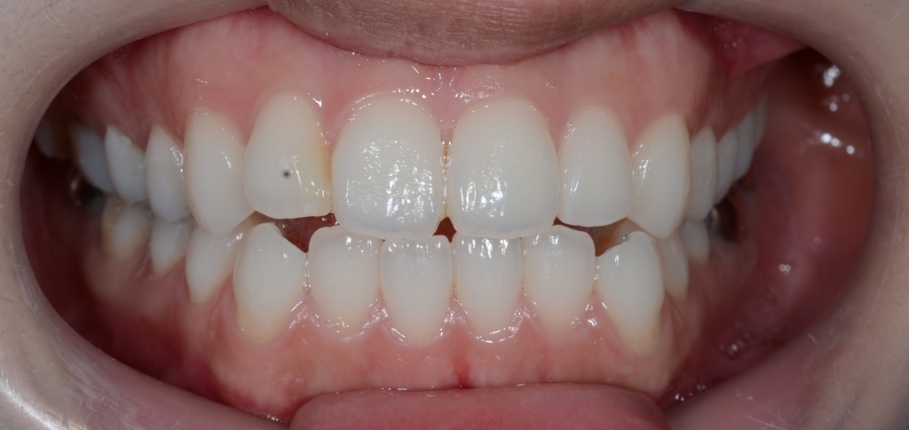 口ゴボを矯正する前の歯並び