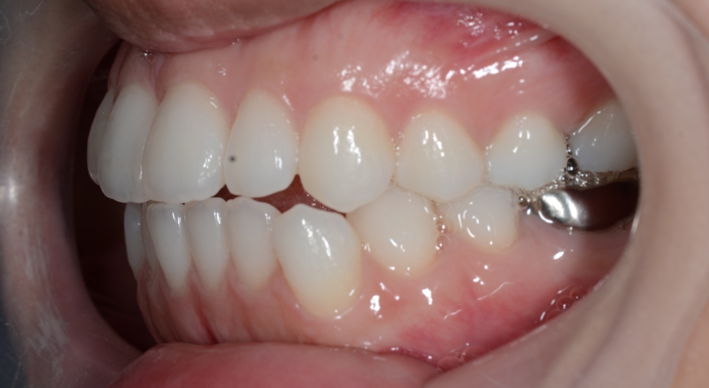 口ゴボを矯正する前の歯並び