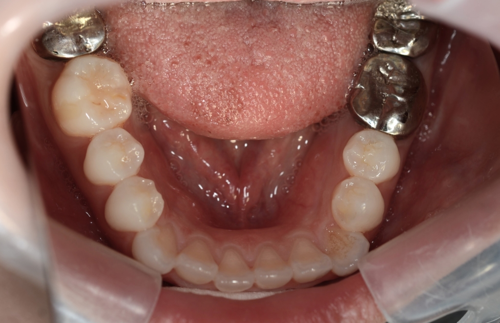 口ゴボを矯正する前の歯並び
