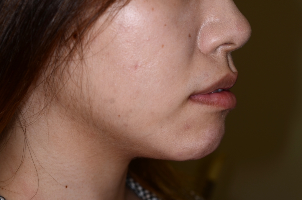 口ゴボを矯正する前の横顔と口元