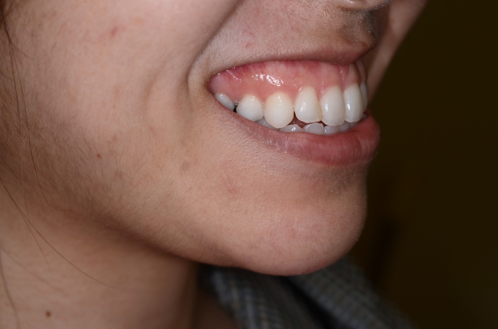 口ゴボを矯正する前の笑顔(ガミースマイル)