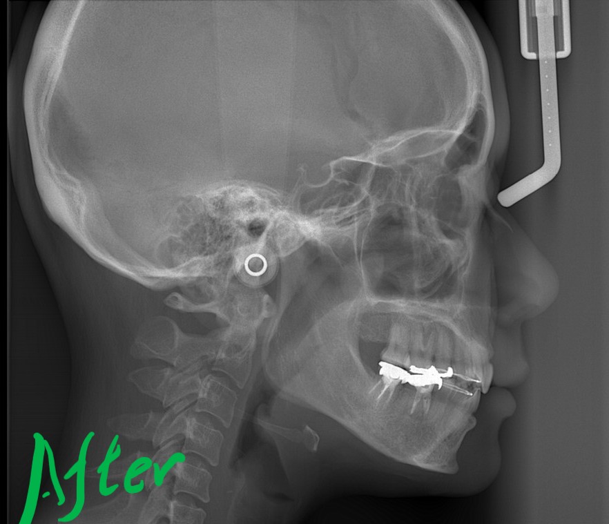 口ゴボを矯正した後の頭部を横から見たレントゲン写真