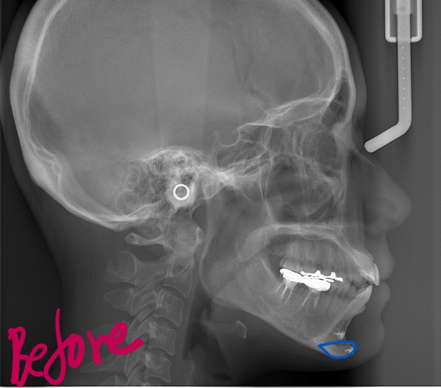 口ゴボを矯正する前の頭部を横から見たレントゲン写真