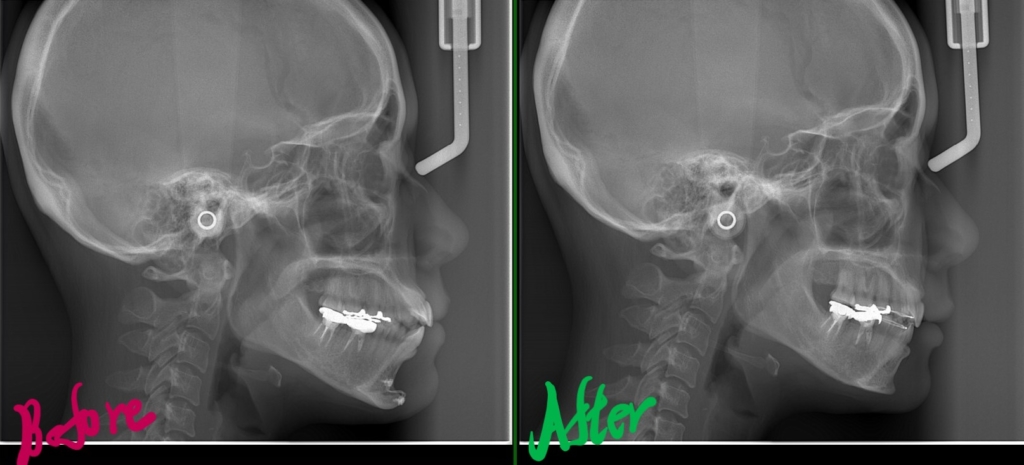 口ゴボを矯正した治療前後のレントゲン写真による比較