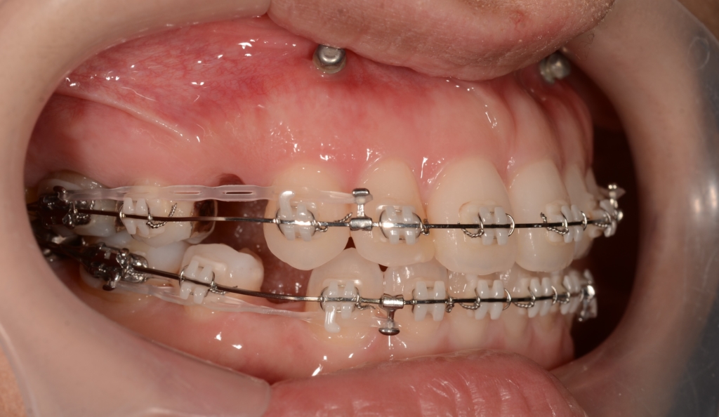マルチブラケットシステムにて抜歯スペースを閉じている途中