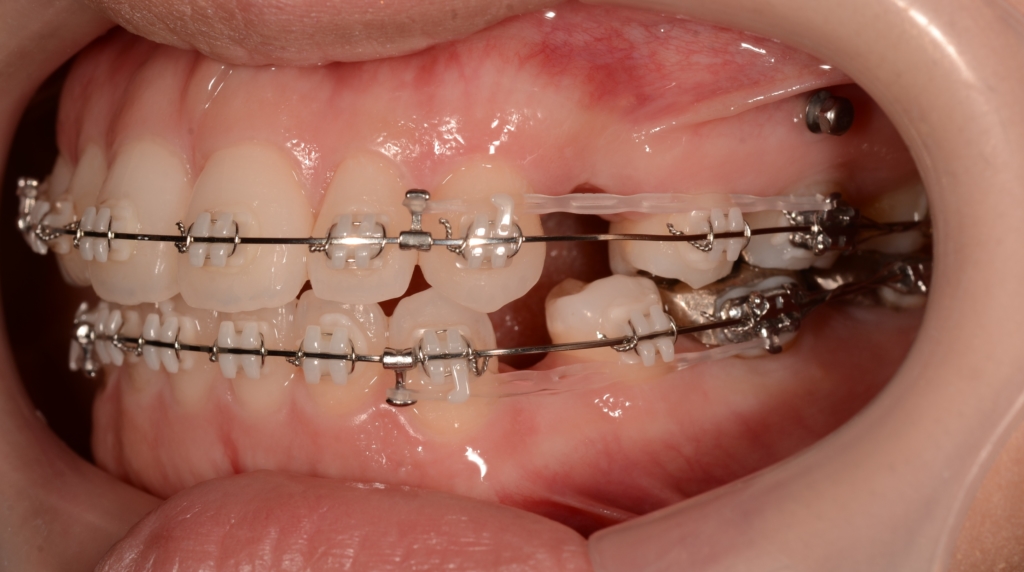 マルチブラケットシステムにて抜歯スペースを閉じている途中