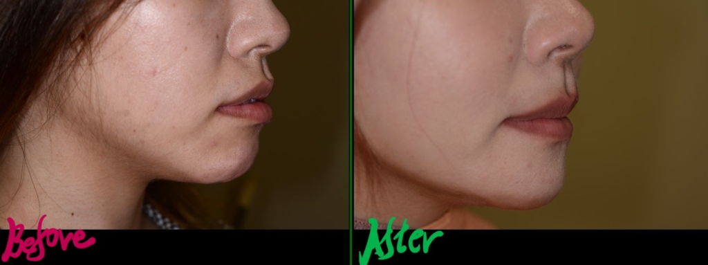 口ゴボを矯正した治療前後の横顔と口元の変化の比較