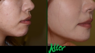 口ゴボを矯正した治療前後の横顔と口元の変化の比較