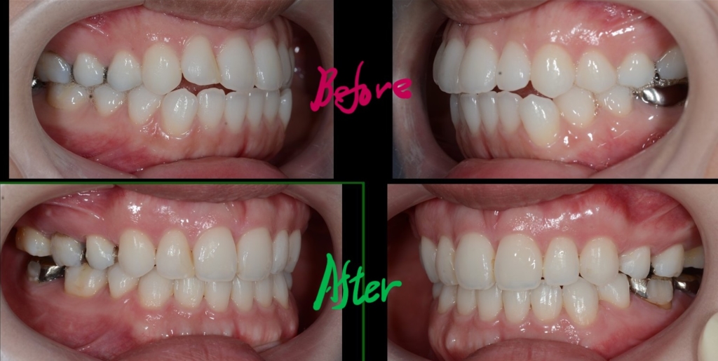 口ゴボを矯正した治療前後の歯並びの変化の比較