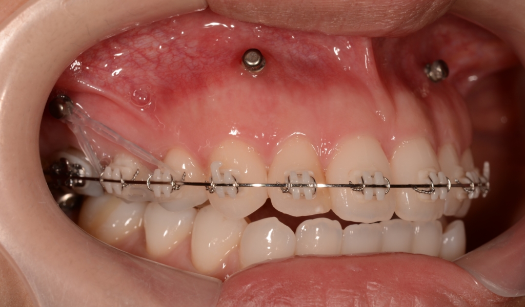 アンカースクリューを用いた矯正治療