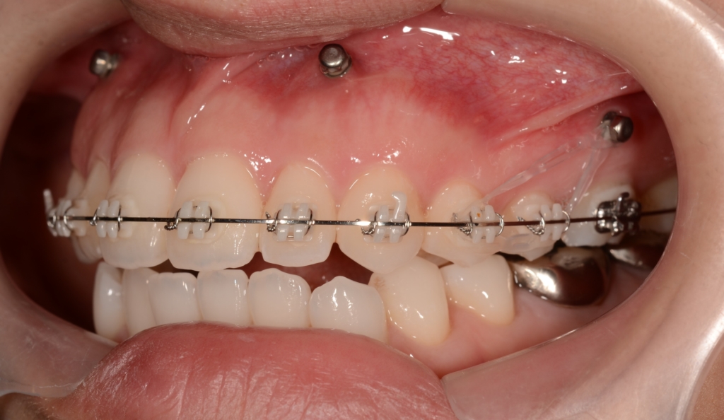 アンカースクリューを用いた矯正治療