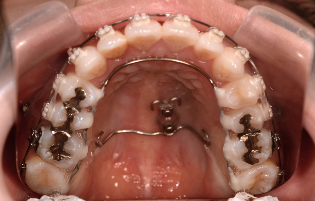 アンカースクリューを用いた矯正治療