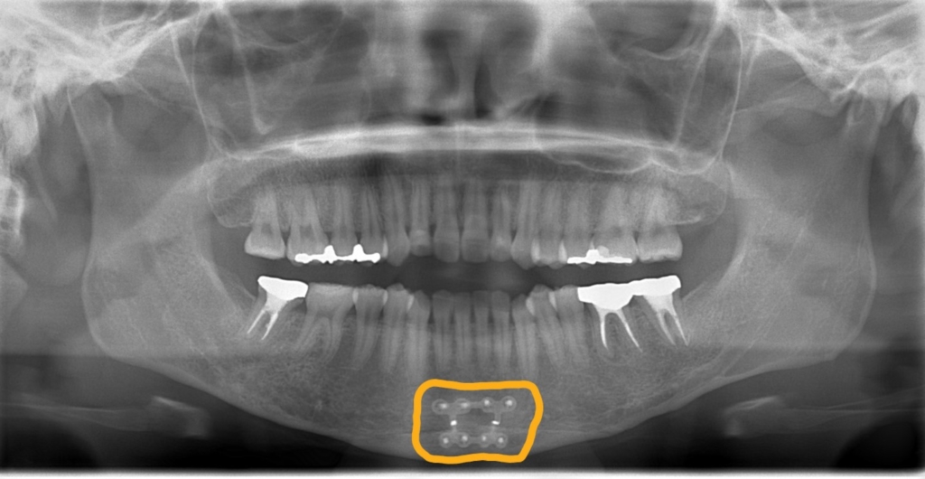 口ゴボの矯正前の顎全体のレントゲン写真