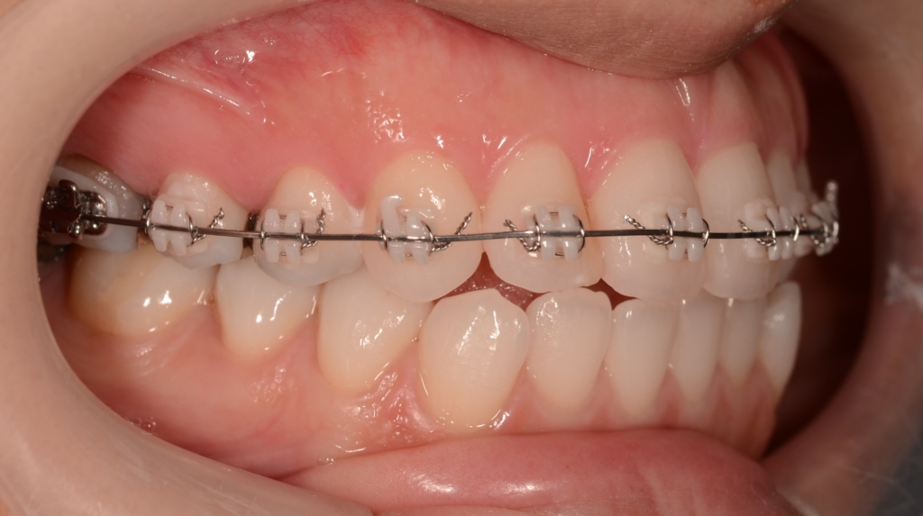 マルチブラケットシステムで矯正治療開始