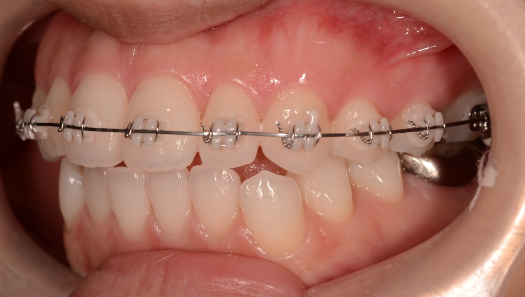 マルチブラケットシステムで矯正治療開始