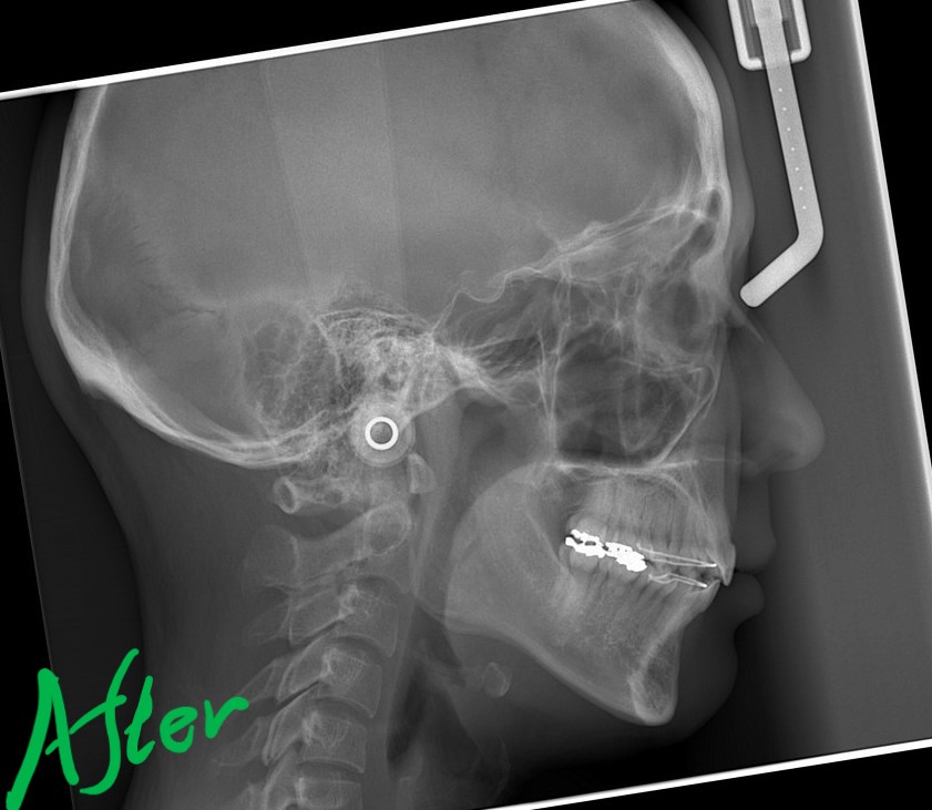 八重歯を矯正した後の頭部を横から見たレントゲン写真