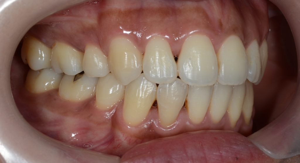 八重歯を矯正した後の歯並び