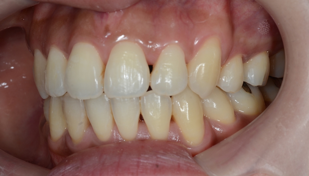 八重歯を矯正した後の歯並び