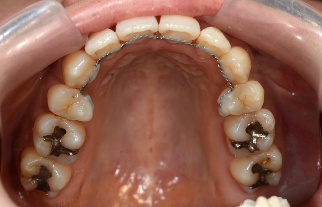 八重歯を矯正した後の歯並び