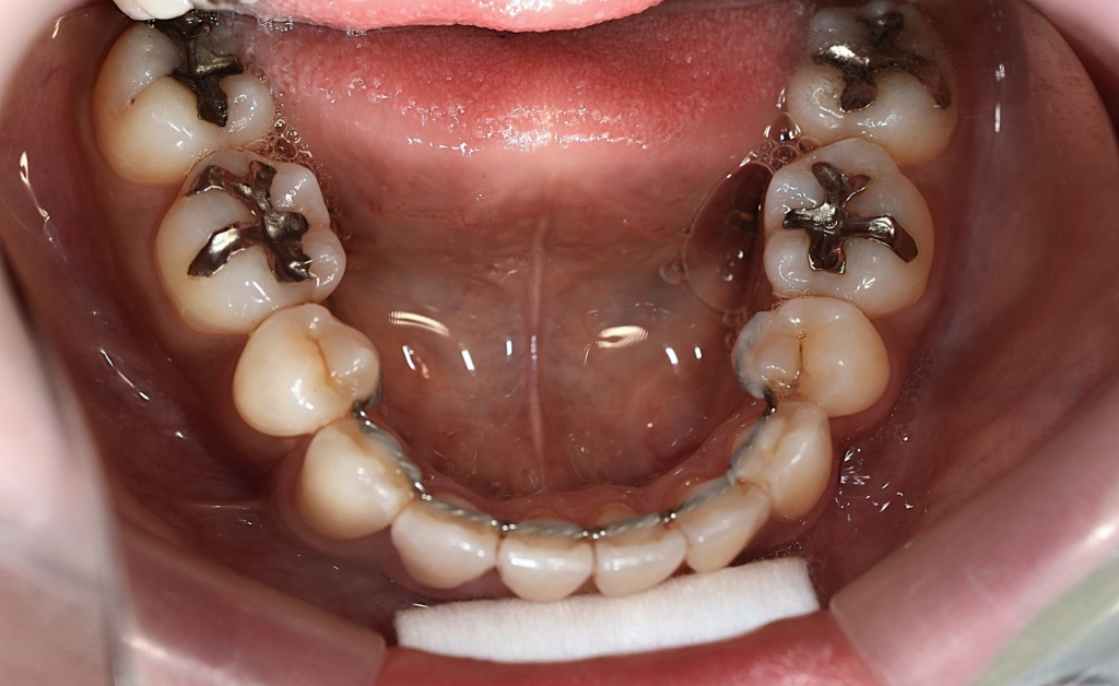 八重歯を矯正した後の歯並び