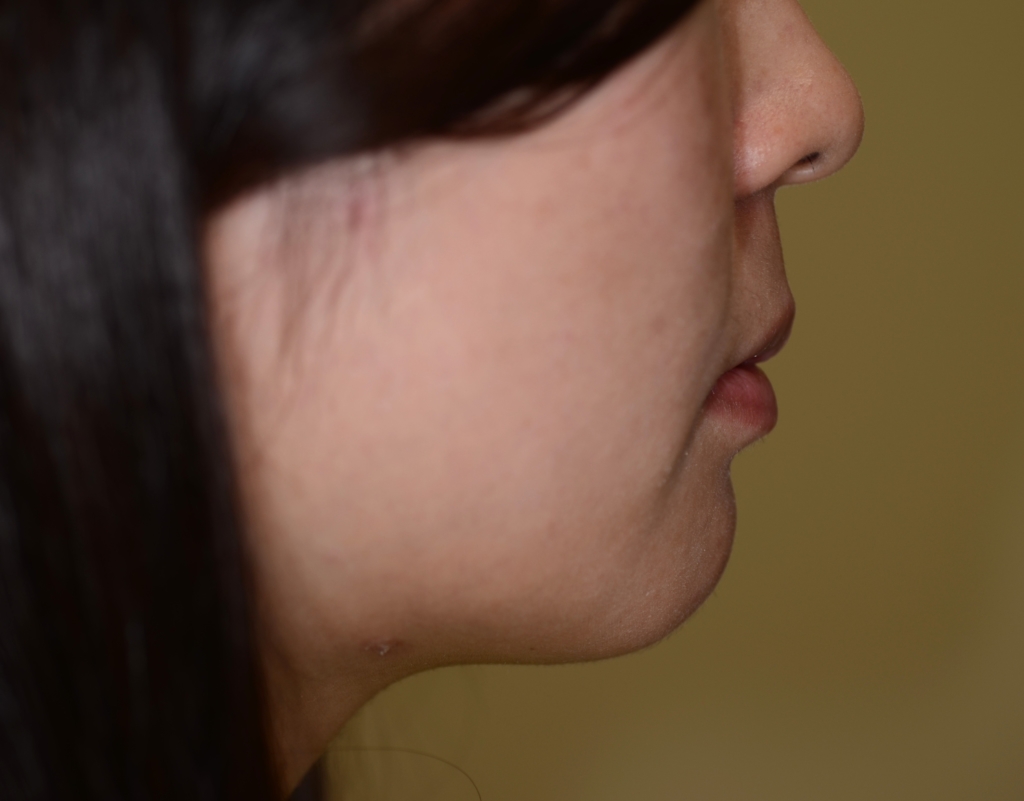 八重歯を矯正した後の横顔と口元