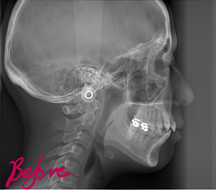 八重歯を矯正する前の頭部を横から見たレントゲン写真