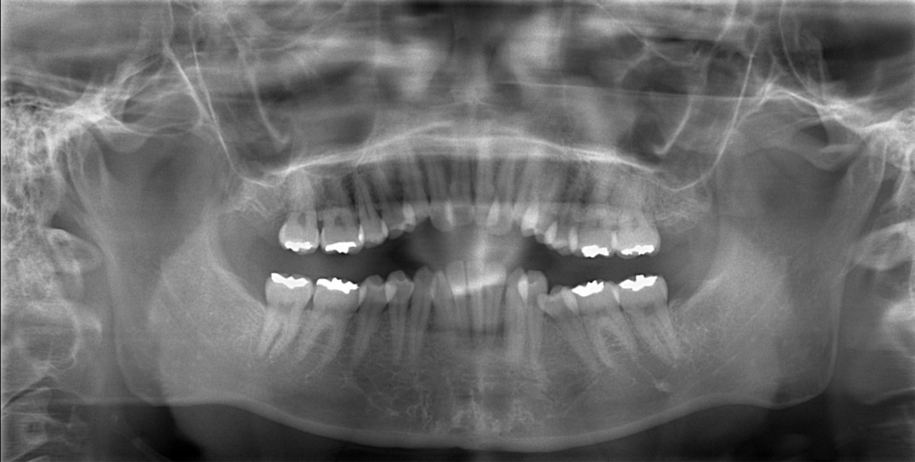 八重歯を矯正する前の顎全体のレントゲン写真