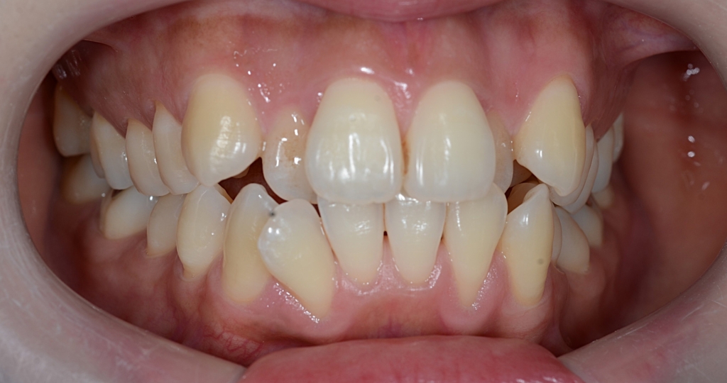 八重歯を矯正する前の歯並び