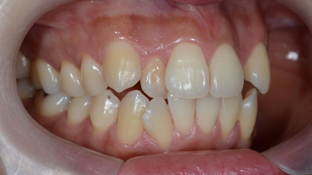 八重歯を矯正する前の歯並び