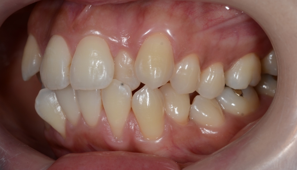 八重歯を矯正する前の歯並び