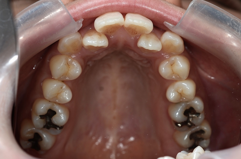 八重歯を矯正する前の歯並び