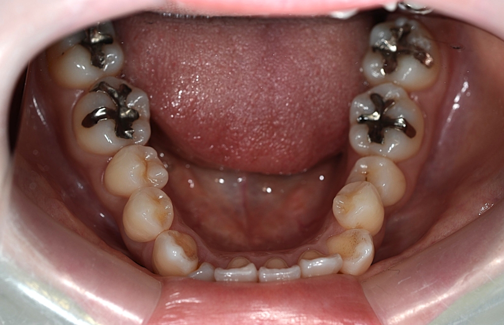 八重歯を矯正する前の歯並び