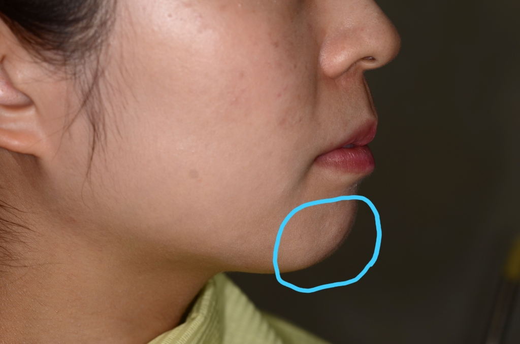 八重歯を矯正する前の横顔と口元