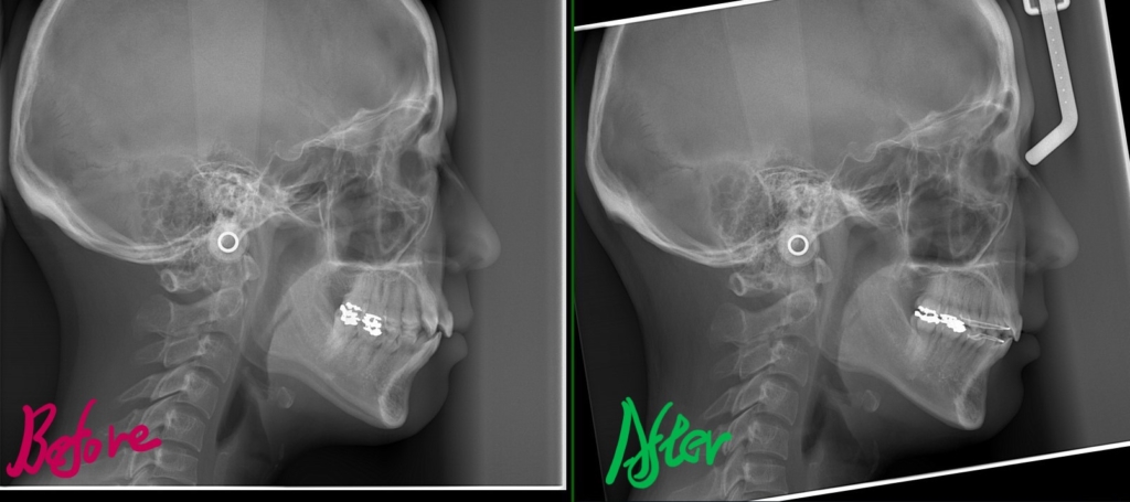 八重歯を矯正した治療前後のレントゲン写真による比較