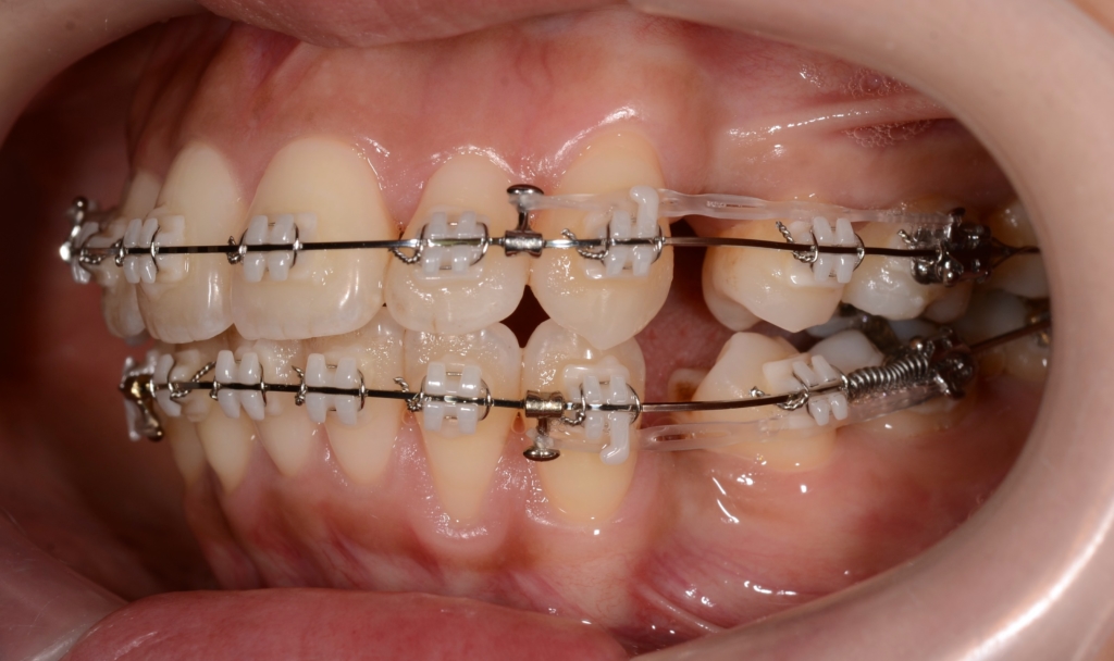 マルチブラケットシステムにて抜歯スペースを閉じている途中