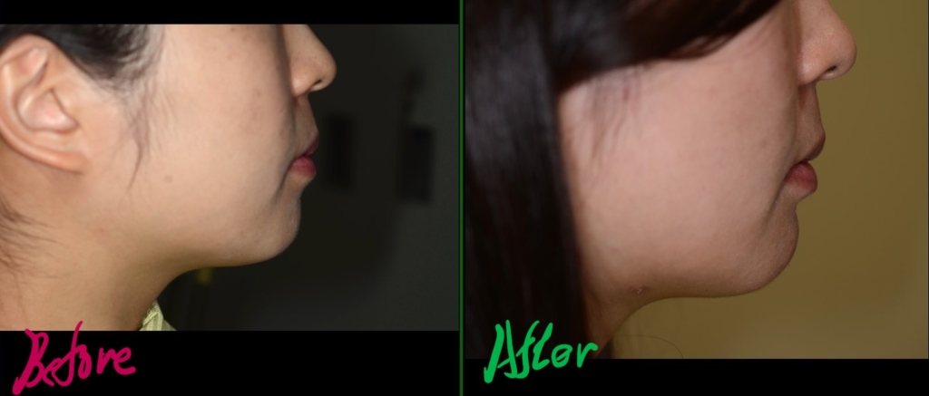 八重歯を矯正した治療前後の横顔と口元の変化の比較