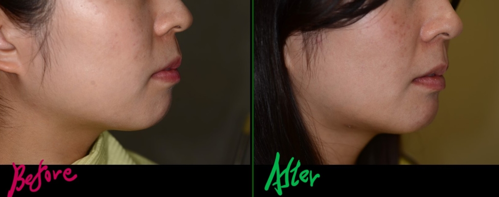 八重歯を矯正した治療前後の横顔と口元の変化の比較