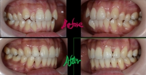 八重歯を矯正した治療前後の歯並びの変化の比較