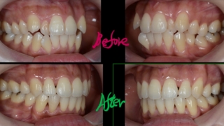 八重歯を矯正した治療前後の歯並びの変化の比較