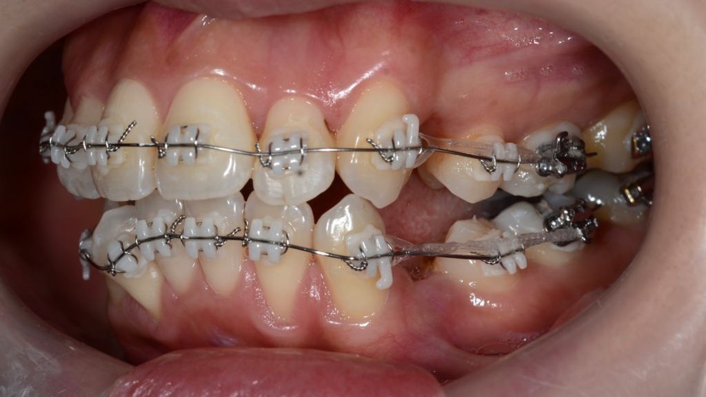 マルチブラケットシステムで矯正治療開始
