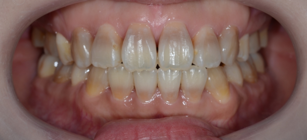 デコボコで開口を矯正した後の歯並び